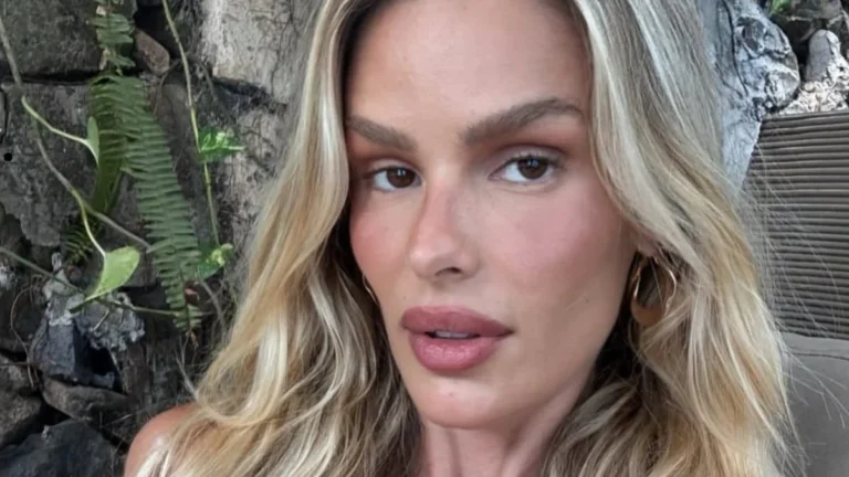 Atualização: Yasmin Brunet revela hematomas do lipedema