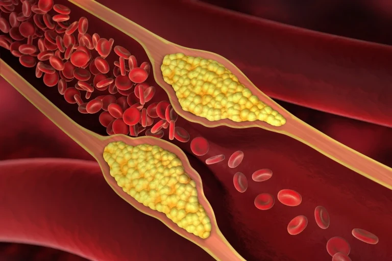 Dicas para baixar o colesterol ruim naturalmente com médico