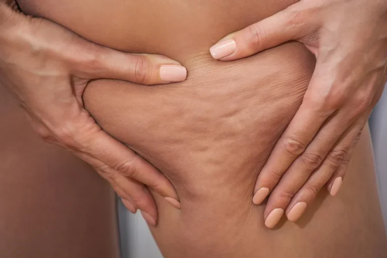 Celulite de inverno: dicas para manter a saúde da pele